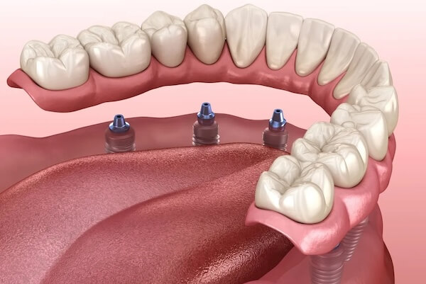 Implant supported bridge