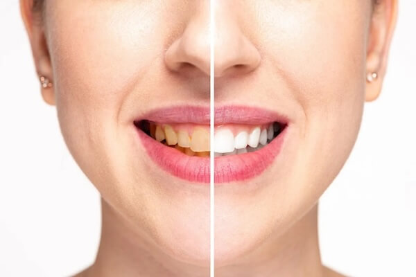 Smile makeover