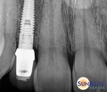 implant x-ray